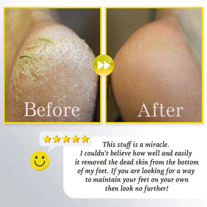 Uppladdningsbar Elektrisk Fotfil för Förhårdnader